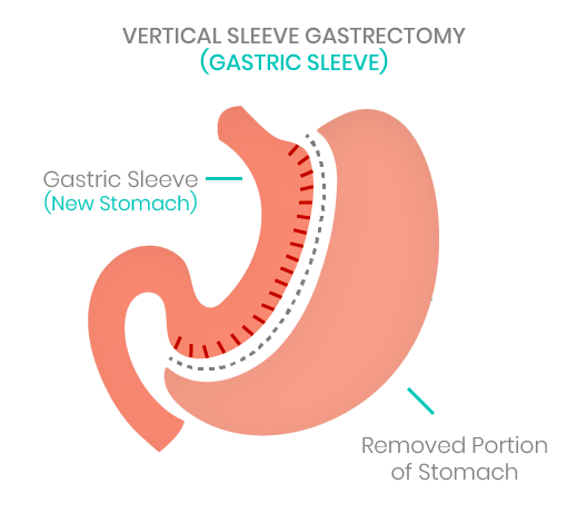 MedicalMex Gastric Sleeve Surgery Patient 