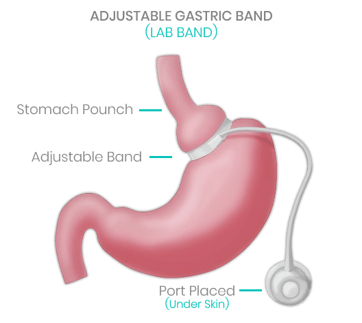 Gastric Band (Lap Band) Surgery