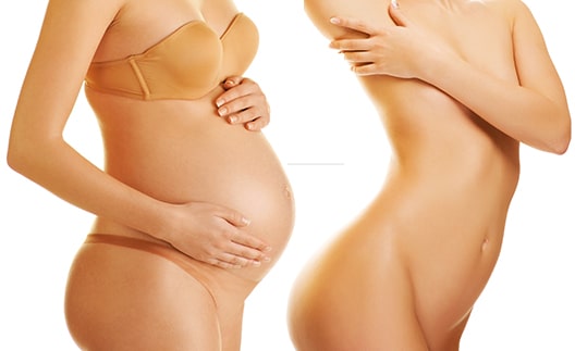 Mommy_Makeover_in_Tijuana
