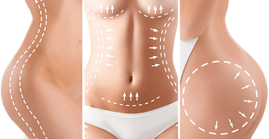 liposuction