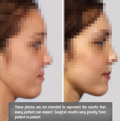 Corrective-Jaw2