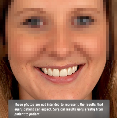implants
