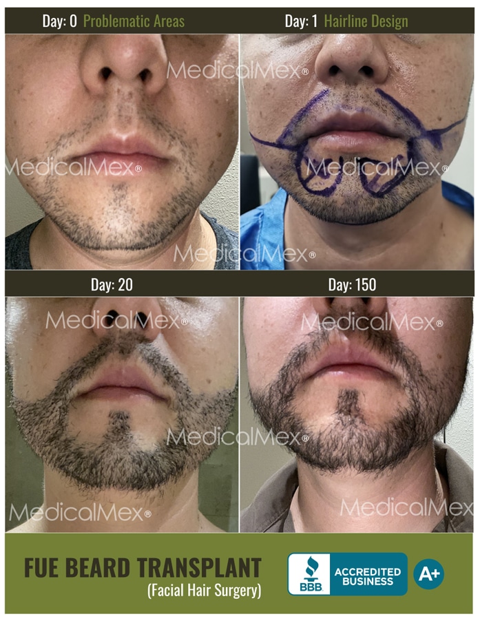 FUE Beard Transplant (Facial Hair) in Tijuana, Mexico | MedicalMex