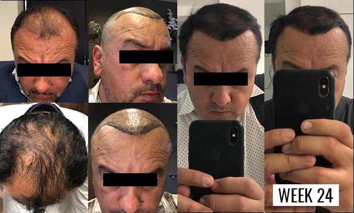 FUE Hair Transplant in Tijuana, Mexico | MedicalMex