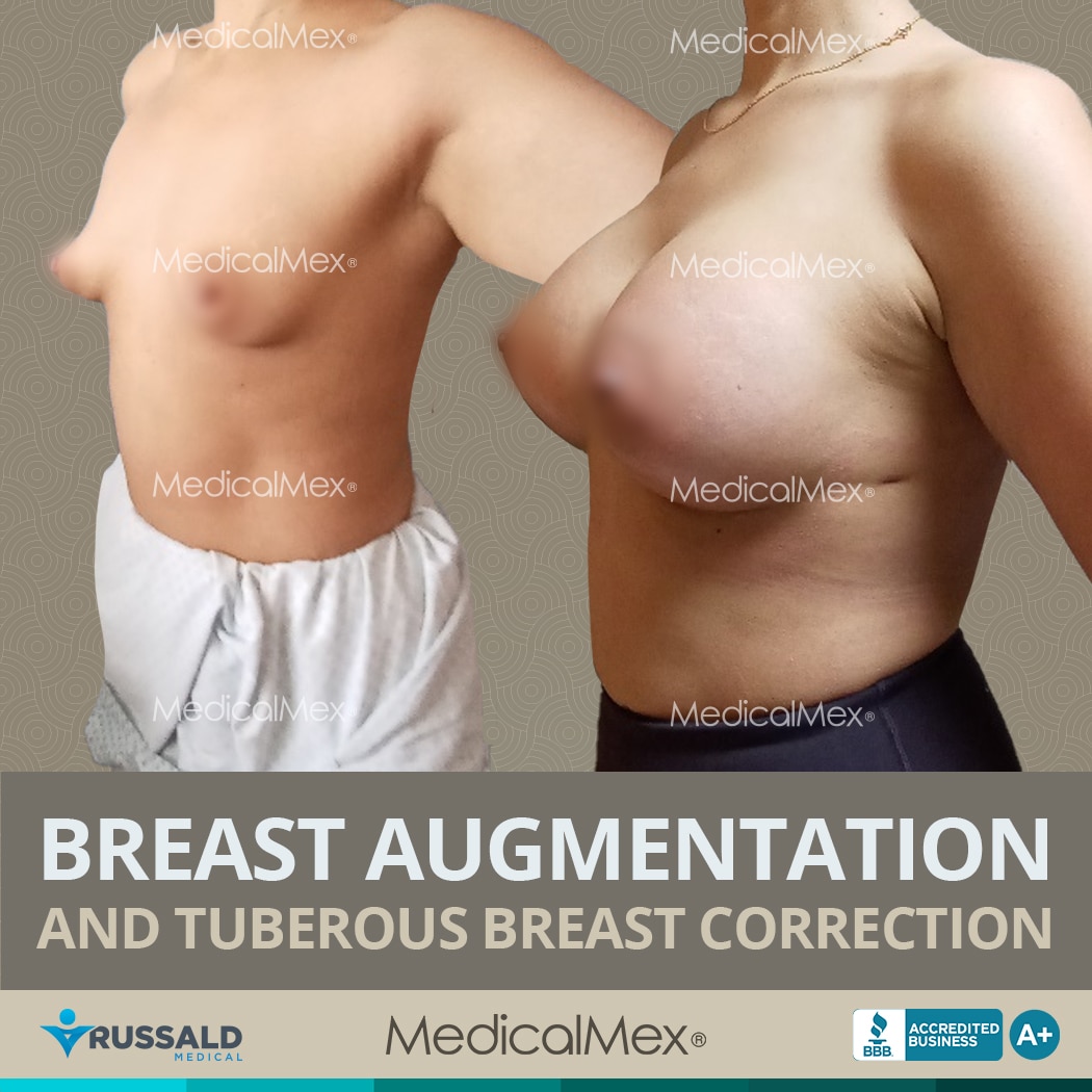 Breast Augmentation Surgery in Tijuana, Mexico - MedicalMex