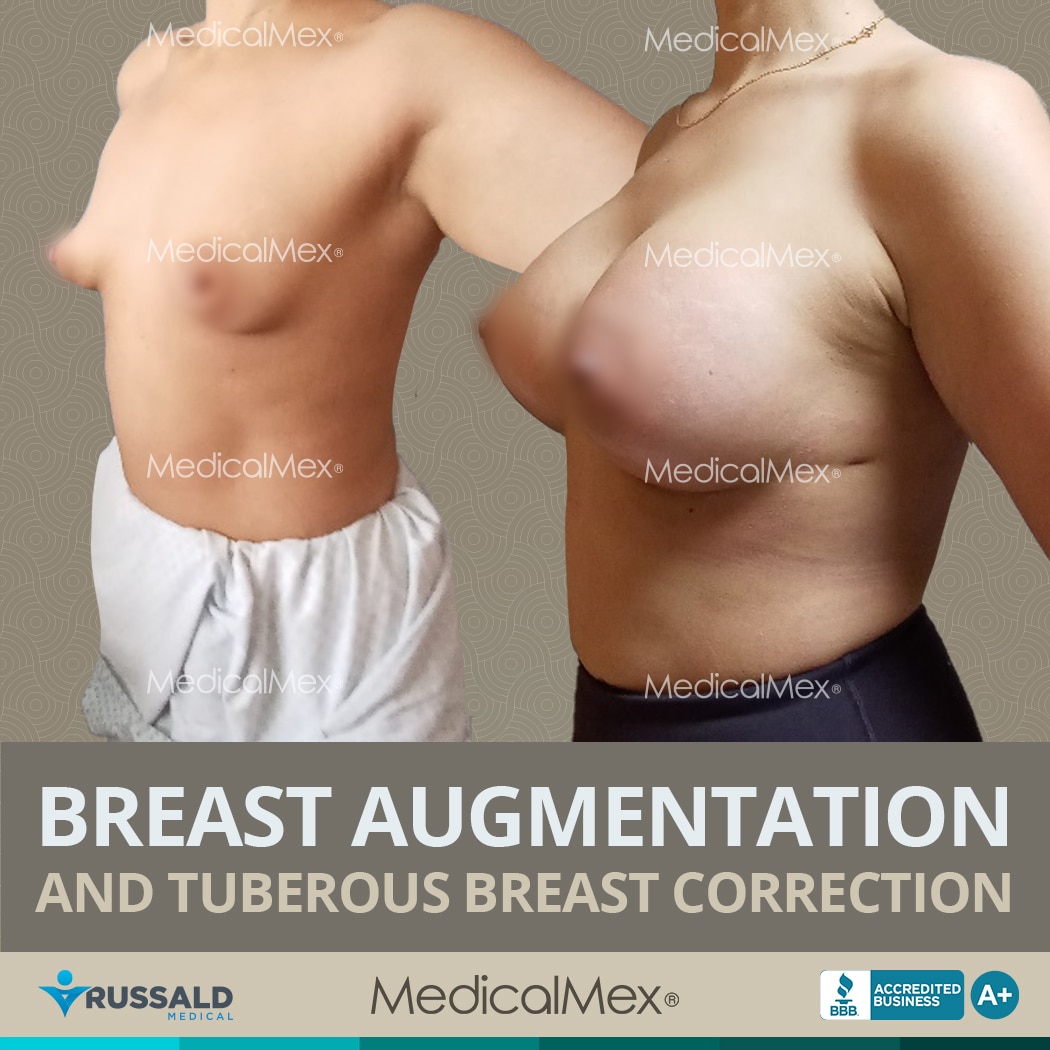 Breast Augmentation