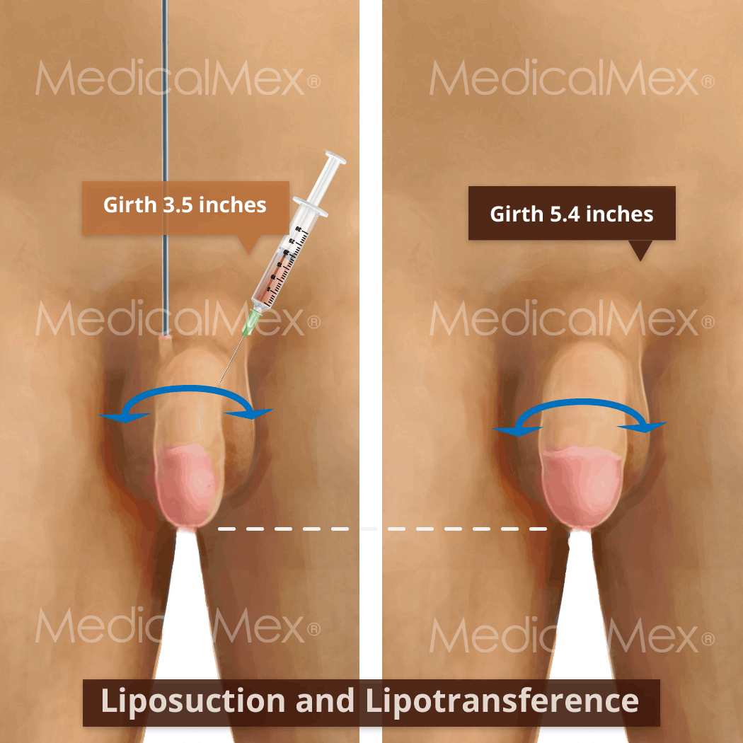 Enlargement of the penis with liposuction and transfer without lengthening 