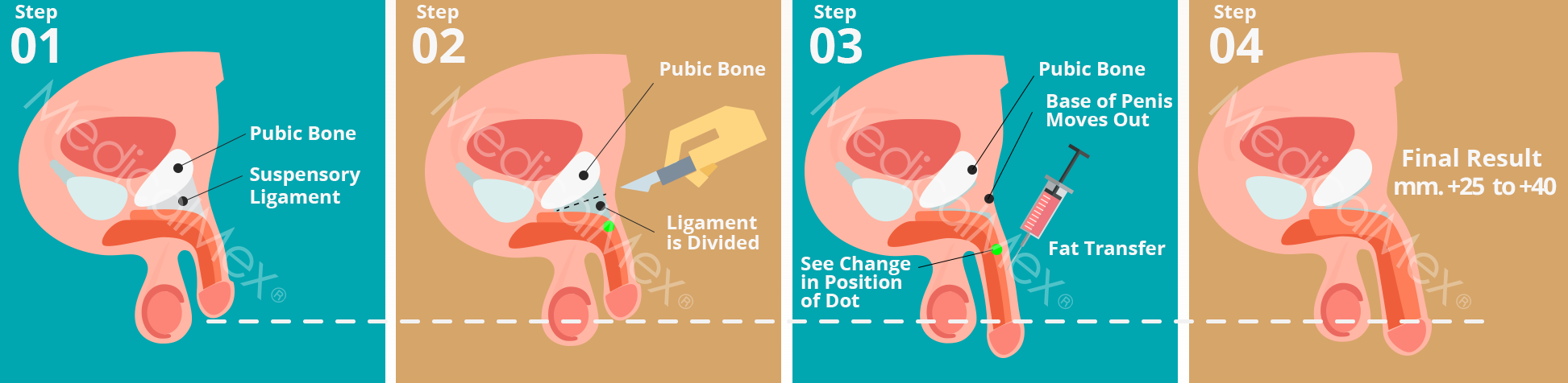 MedicalMex Penis enlargement and thickening with liposuction and lipotransference step by step__