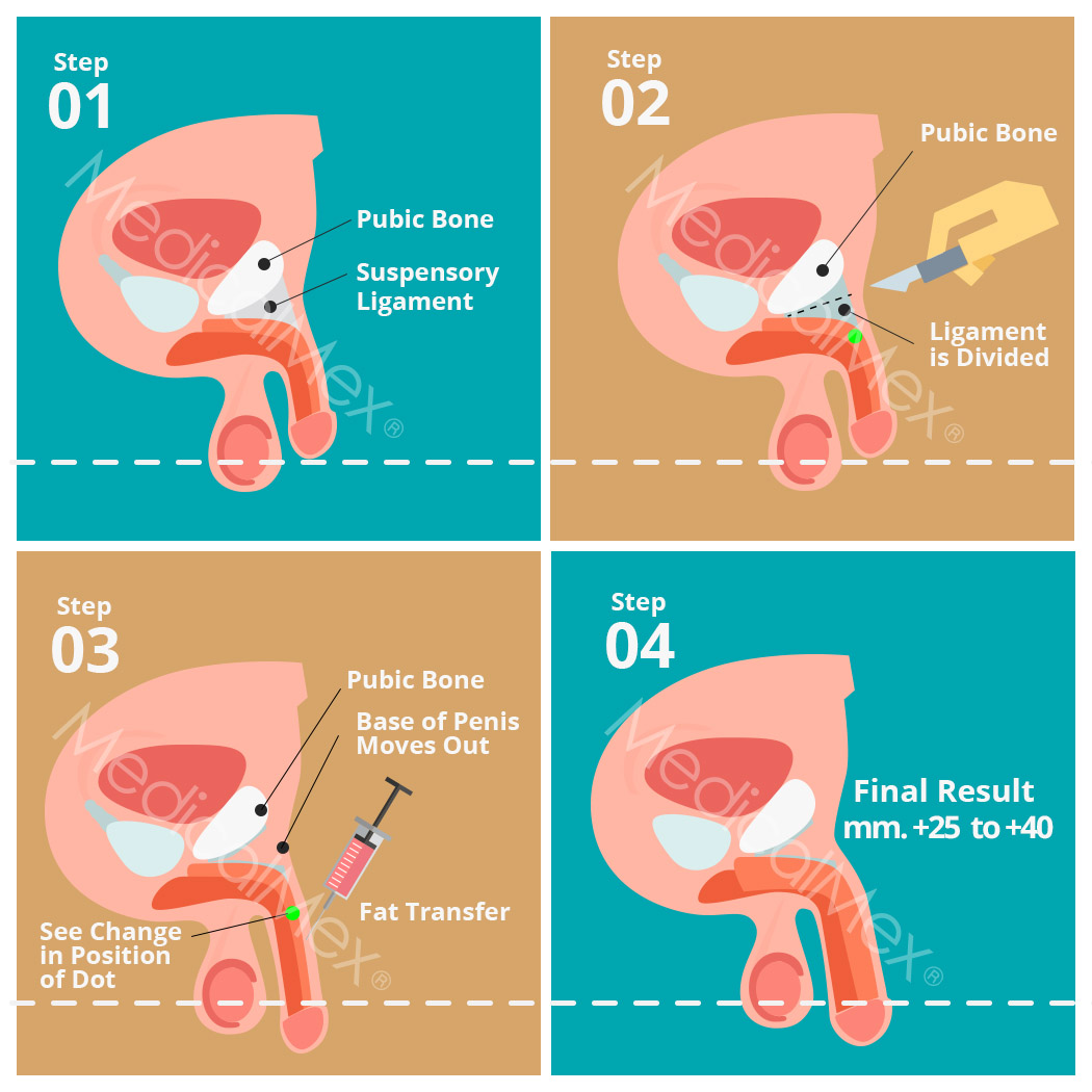 Penis enlargement and thickening with liposuction and lipotransference