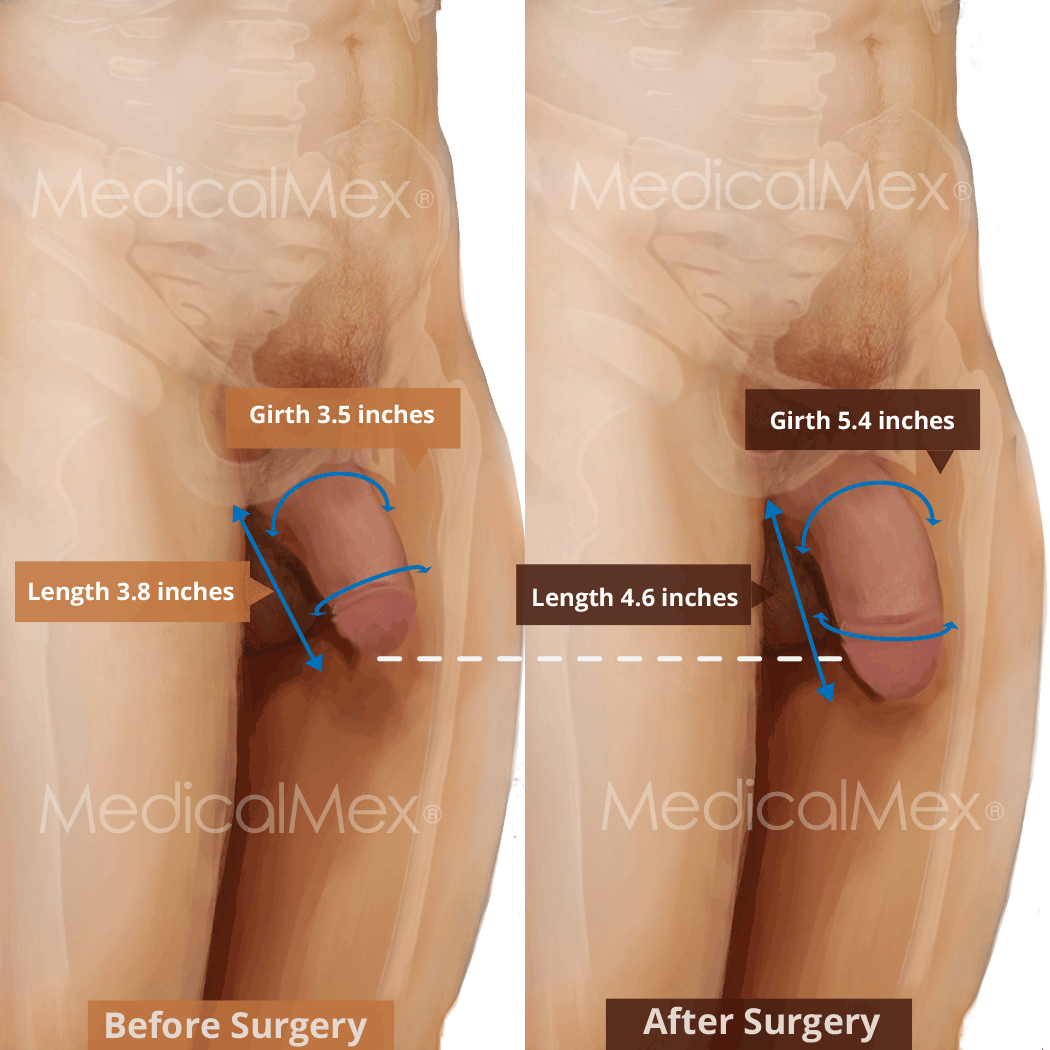 Penis enlargement and thickening with liposuction and lipotransference -  MedicalMex