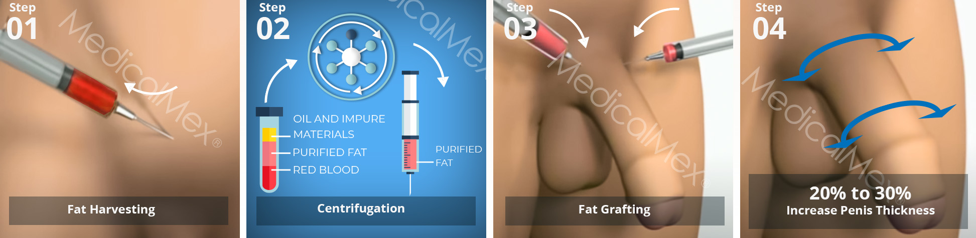 MedicalMex Enlargement of the Penis with Liposuction and Transfer without Lengthening in