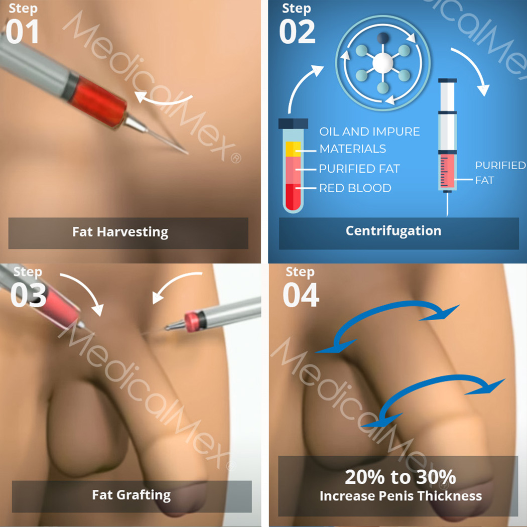 Enlargement of the penis with liposuction and transfer without lengthening 