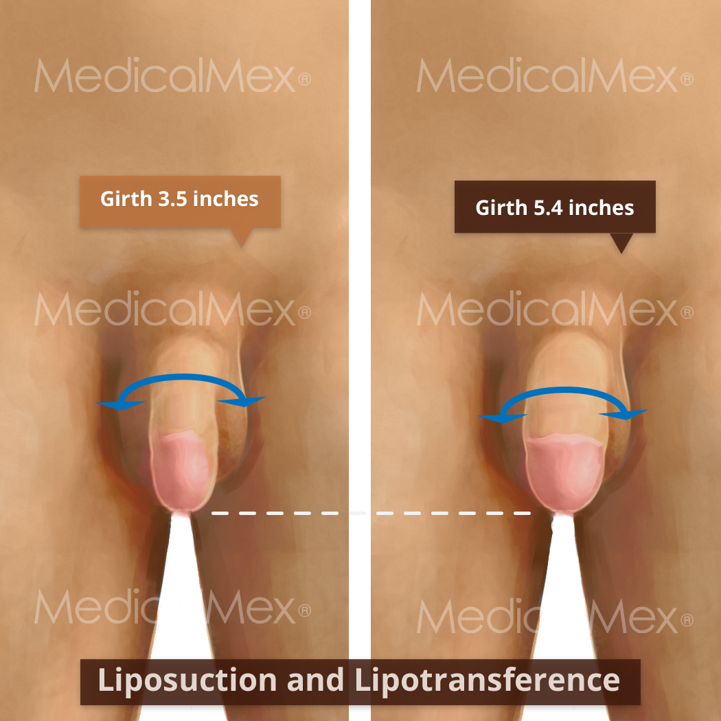 MedicalMex Enlargement of the Penis with Liposuction and Transfer without Lengthening mob2