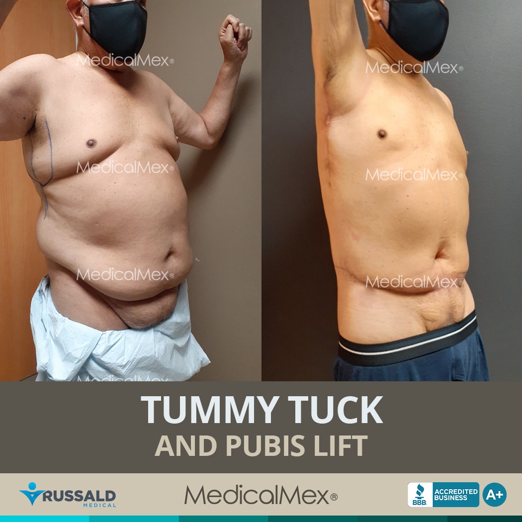 Tummy Tuck in San Diego - Abdominoplasty