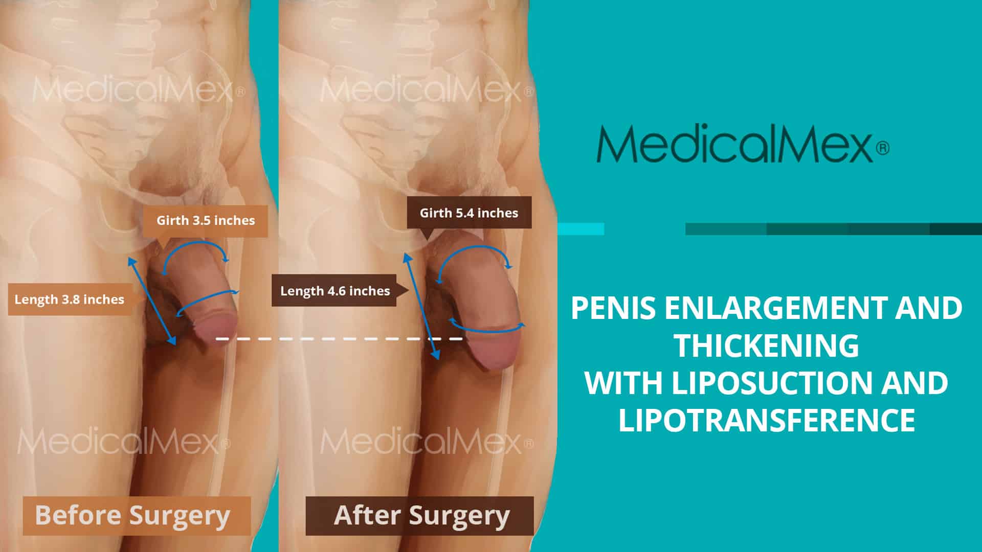 Penis enlargement and thickening with liposuction and lipotransference