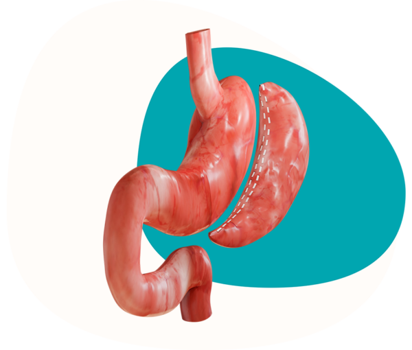 MedicalMex Gastric Sleeve Surgery Patient